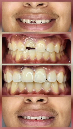 before and after bhutani dental clinic 