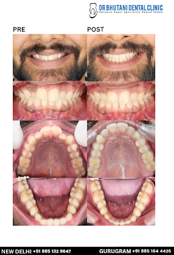 before and after bhutani dental clinic treatment
