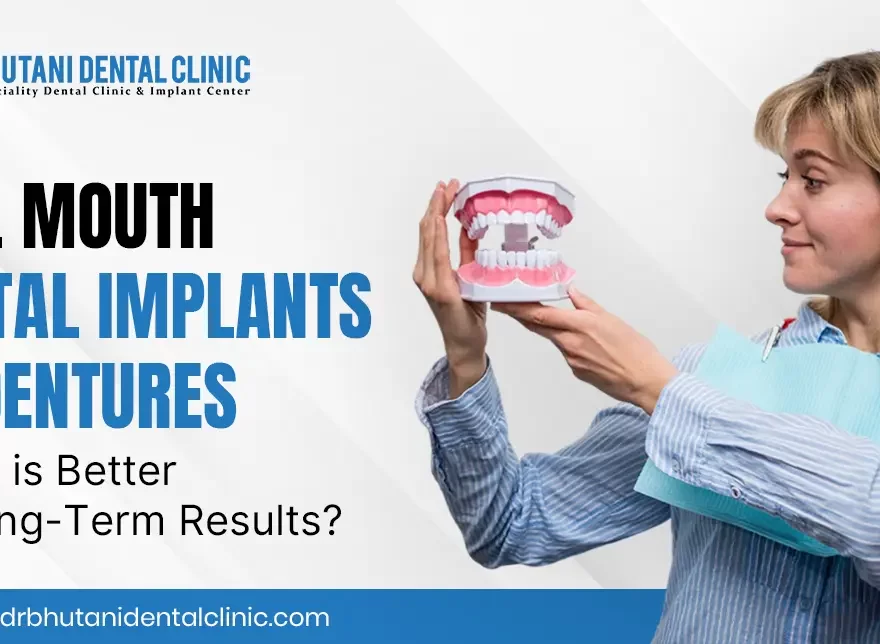 Full Mouth Dental Implant