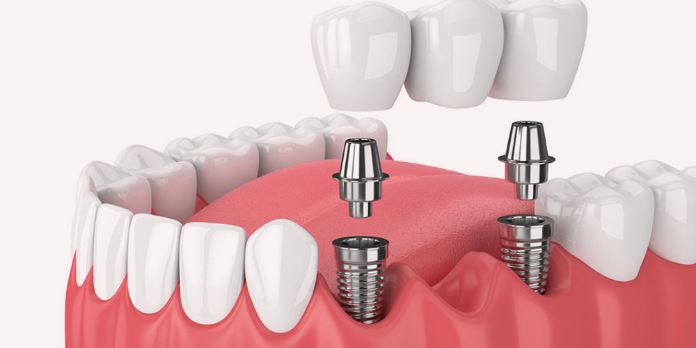 best dental implant clinic in India