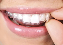Invisible-Teeth-Braces Case Study