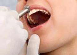 Single-Sitting-Root-CanalTreatment Case Study