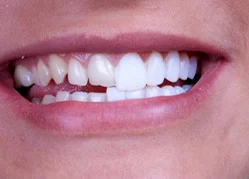 veneers Case Study
