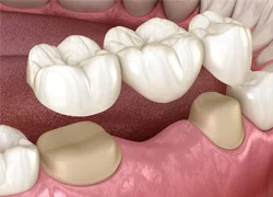 Dental-Brides-image