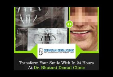 All On 4 Technique- Dental Implants | Dr. Bhutani Dental Clinic