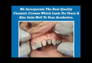 Ceramic Crowns at Dr. Bhutani Dental Clinic in Delhi